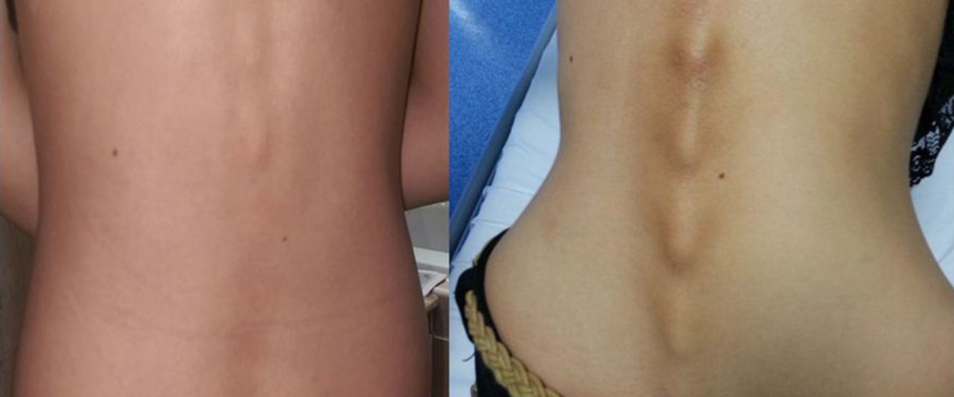 What are 3 complications of anorexia?