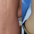 What are 3 complications of anorexia?